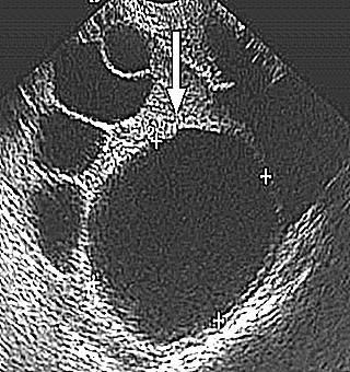 Ultrasound Of The Uterus And Appendages Tvuzi Truzi Tsdk