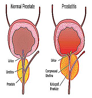 What Can Prostatitis Disease