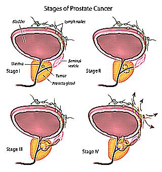 What Can You Confuse With Prostate Cancer