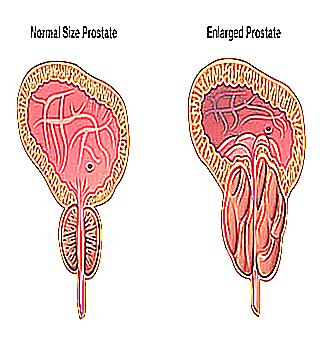 What Caused The Enlarged Prostate
