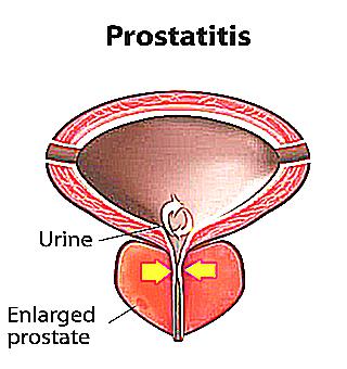 What Does The Prostate Feel Like With Chronic Prostatitis