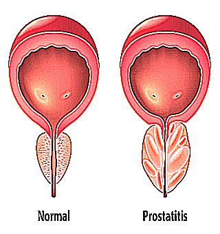 What Not To Eat With Prostatitis