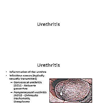 What To Do If Urethritis Does Not Go Away
