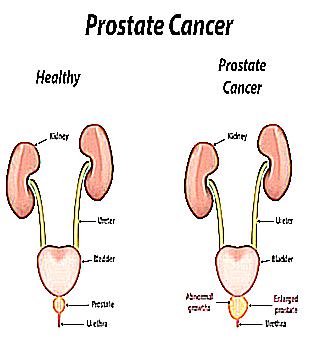 What To Feed Patients With Prostate Cancer