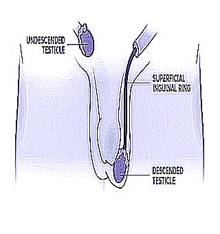 Are Small Testicles A Sign Of Male Infertility