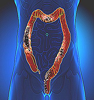 Why Does Blood Flow With Prostate Adenoma